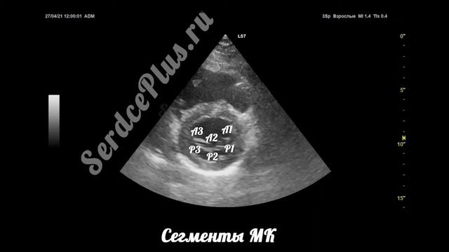 ЭхоКГ. Створки и сегменты митрального клапана смотреть онлайн