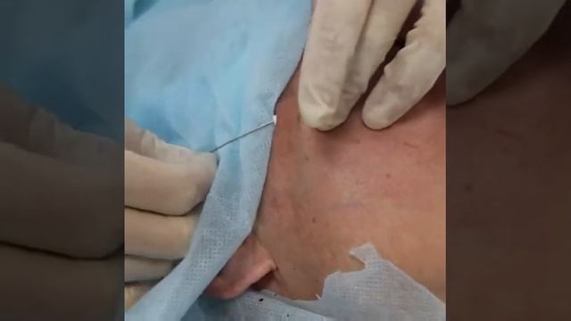 КЛИНИКА21. Нитевой лифтинг Aptos смотреть онлайн