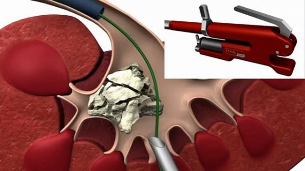 Литотриптор