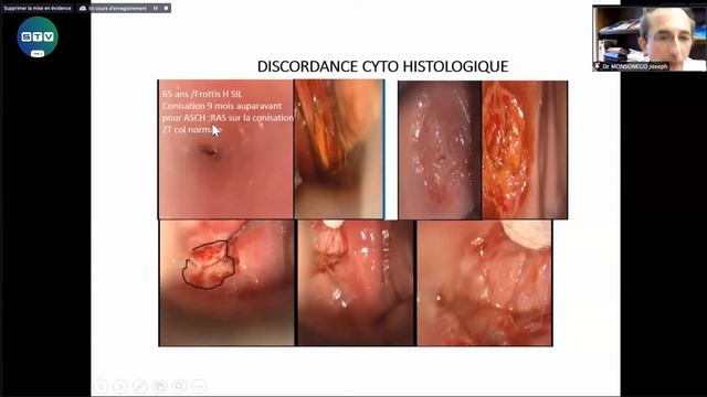38e Congrès de la SMFC - Session 2 : Colposcopie смотреть онлайн