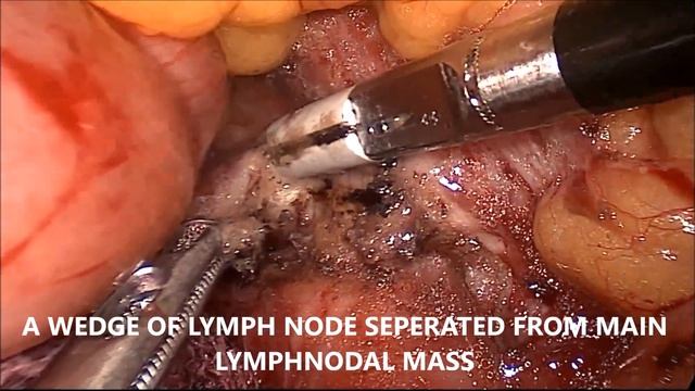 Laparoscopic Para-aortic Lymph node Biopsy смотреть онлайн