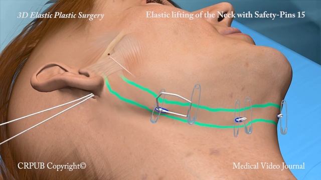 41. 3D Elastic lifting of the neck with safety pins смотреть онлайн