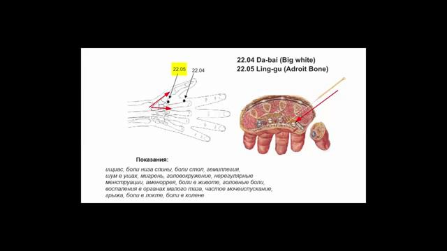 Мастер Тонг акупунктура Боли спины
