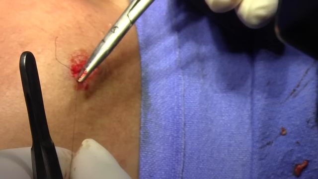 Naevus Mole Cheek: Excision & Closure смотреть онлайн