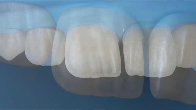 Реставрация переднего зуба композитом Capo Natural (Schutz). Front Tooth Composite Restoration.
