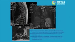 Дегенеративные изменения позвоночника на МРТ