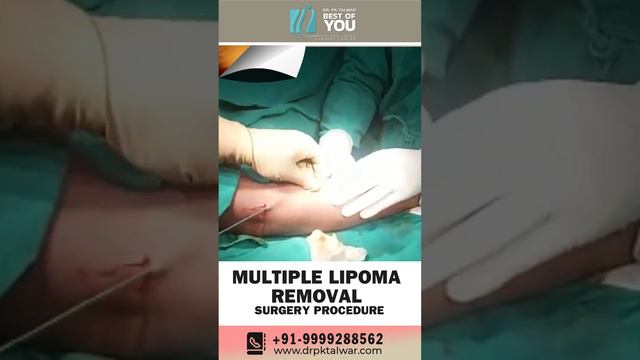 Multiple Lipoma Removal Procedure & Its Results | Before-After Results of Multiple Lipoma Removal смотреть онлайн