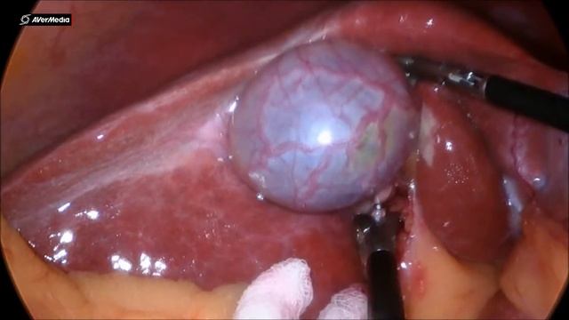 Single Incision Laparoscopic (SILS ) Cholecystectomy