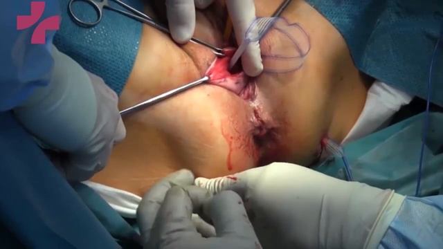 AUA 2017. Post-hysterectomy vaginal vault prolapse repair: apical sling and "neocervix" formation смотреть онлайн