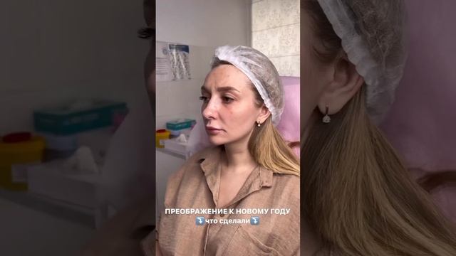 Омоложение лица с помощью комплексного метода Full Face: минус 5-10 лет за процедуру! смотреть онлайн