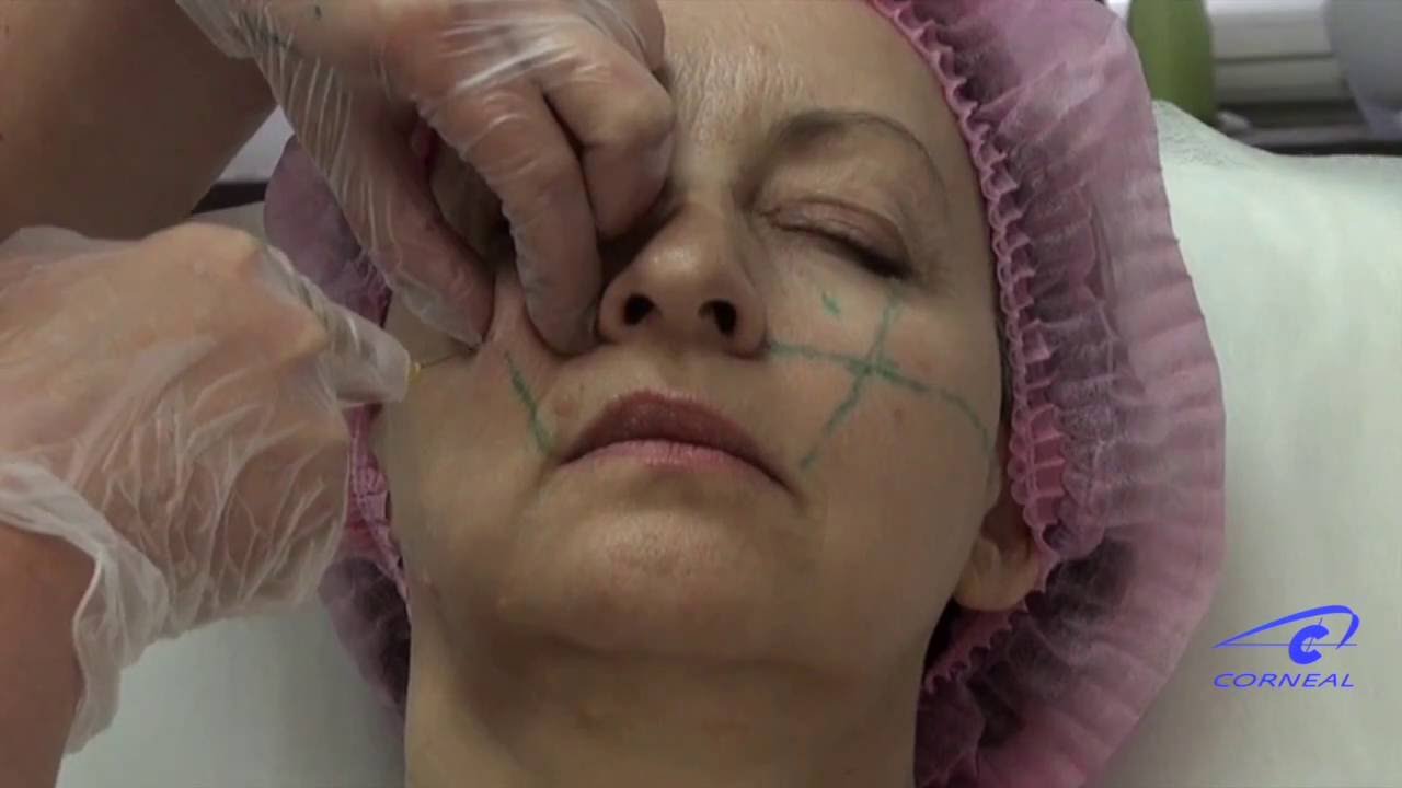 Укладываем канюлю в носослезную борозду смотреть онлайн