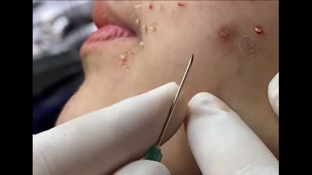 Удаление черных точек 2021 - Remoção de cravo 2021 - Pimple Popping 2021 -Blackhead Removal Ep01 смотреть онлайн