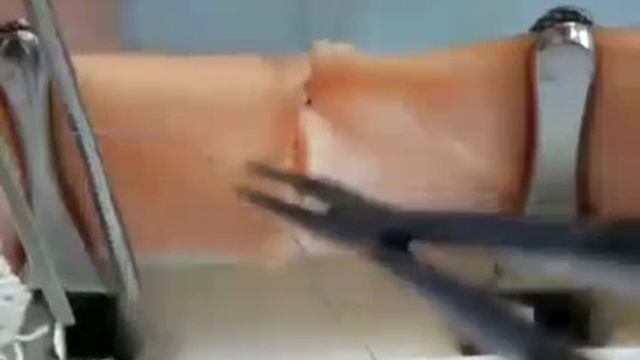 Циркулярный обвивной шов по Каррелю смотреть онлайн