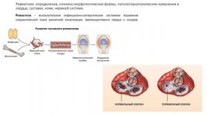 Патологическая анатомия | РЕВМАТИЗМ