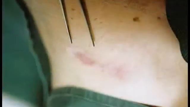 Cryoscience and Cryomedicine: Cryosurgery for Lymph Node Metastases смотреть онлайн