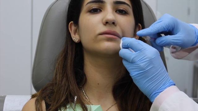 Demonstration Belotero Volume Filler Lip With Micro Cannula Dr. Nabil Fakih