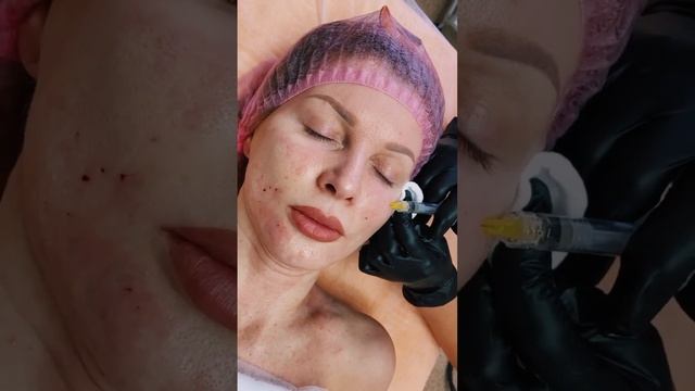 #барнаул #косметология #салонкрасотылеон #биоревитализация смотреть онлайн