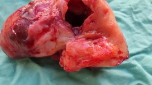 Острый аппендицит. Червеобразный отросток. Макропрепарат.