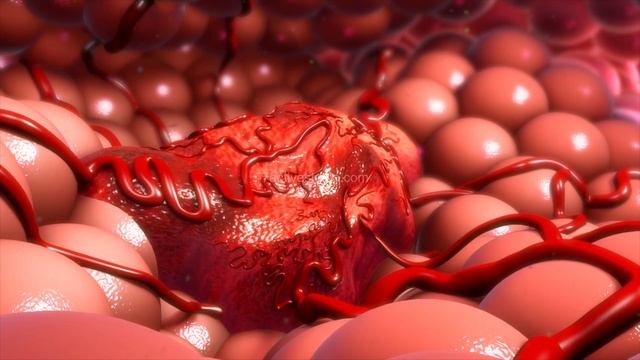 క్యాన్సర్ (కీమోథెరపీ)| Cancer (Chemotherapy) | Telugu смотреть онлайн