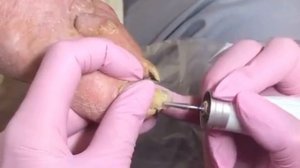 Обработка ногтей у пожилого человека ?⚠️?❗️❗️❗️??