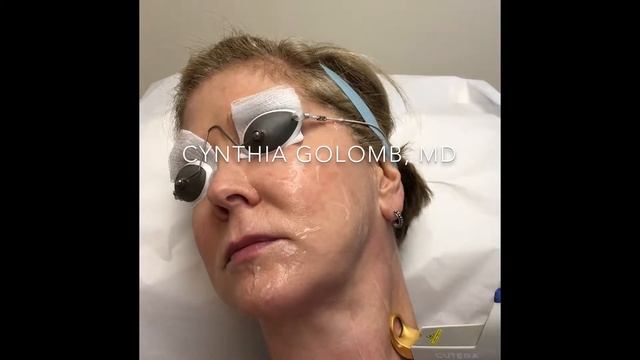 excel V treatment of sun damage and discoloration on neck смотреть онлайн