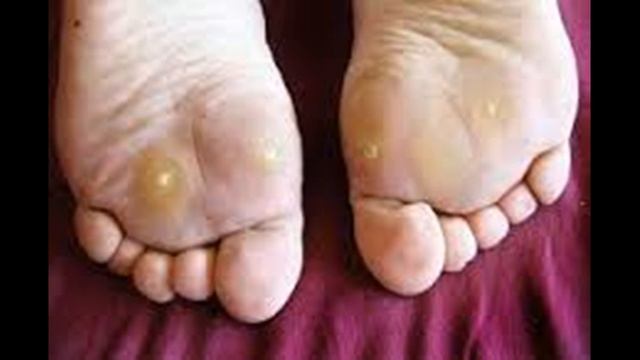 Как лечить и вылечить натоптыши смотреть онлайн