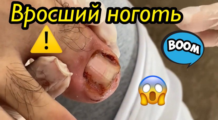 Вросший ноготь??⚠️?? смотреть онлайн