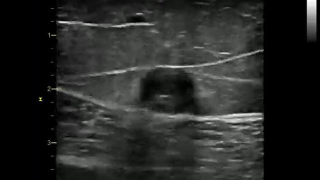 Тромбоз БПВ