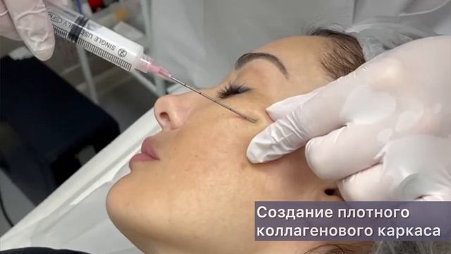 Инъекции полимолочной кислоты смотреть онлайн