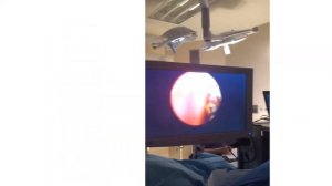 Лазерная вапоризация аденомы предстательной железы. Удаление аденомы тулиевым лазером (Москва)