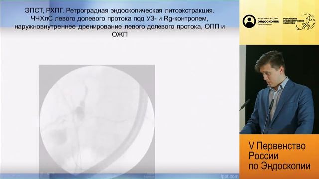 Множественный холедохолитиаз смотреть онлайн