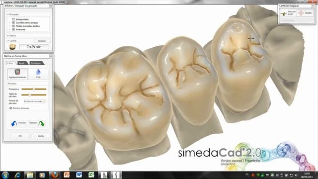 simedCAD (exoCAD) Tru-Smile смотреть онлайн