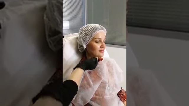 ИНЪЕКЦИОННОЕ СУЖЕНИЕ НОСА Mesosculpt C71