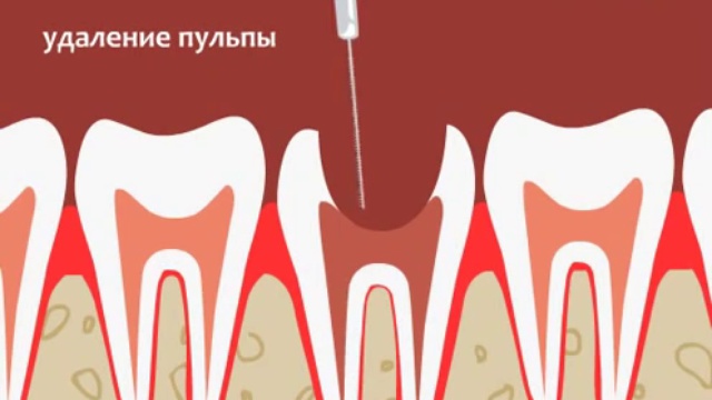 Хирургическое лечение пульпита