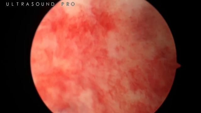 Гістероскопія смотреть онлайн