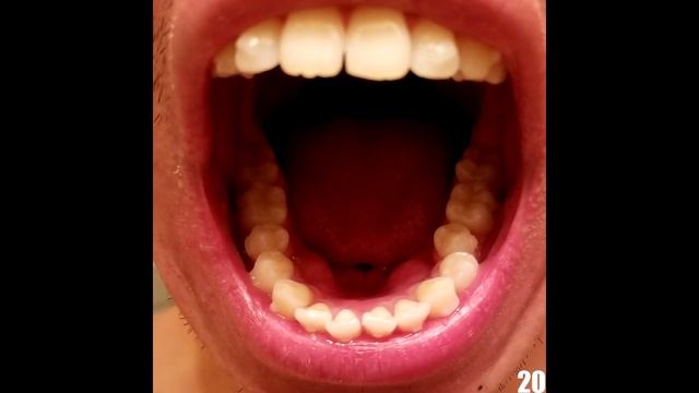 Invisalign Full Time-lapse смотреть онлайн
