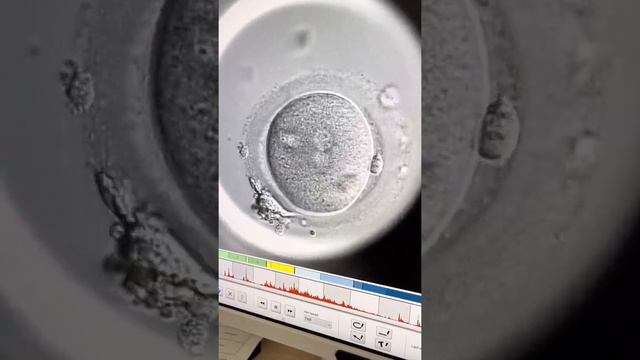 ЭКО с эмбриоскопом: клинический случай смотреть онлайн