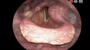 Эндоскопия гортани: новообразование гортаноглотки