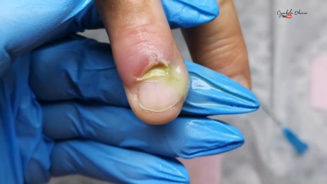 ПАНАРИЦИЙ. Воспаление кутикулы. Сорвала заусенец. Гной под ногтем. Обработка нарыва пошаговое видео