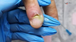 ПАНАРИЦИЙ. Воспаление кутикулы. Сорвала заусенец. Гной под ногтем. Обработка нарыва пошаговое видео