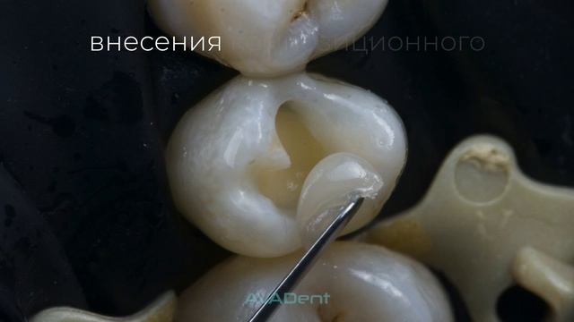 AVADent. Что если дефект менее 30%? смотреть онлайн