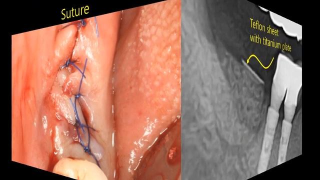 Применение тефлоновой мембраны при GBR смотреть онлайн