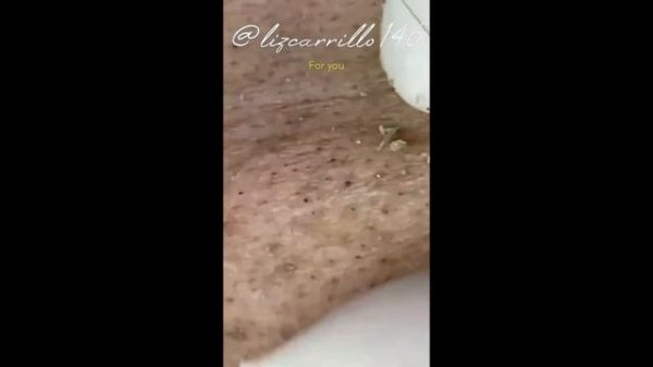 Popping Huge Blackheads And Pimple Popping - Best Pimple Popping Videos #13