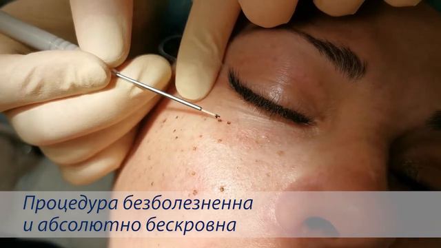 Удаление множественных новообразований лазером смотреть онлайн