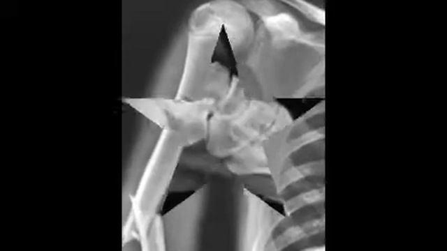Top 6 disgusting broken bones. смотреть онлайн
