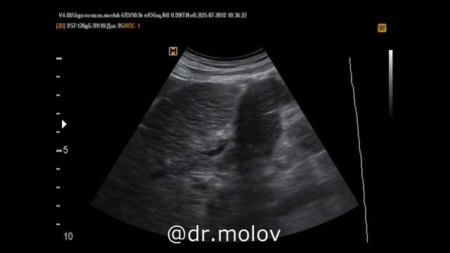 Тромбоз воротной вены+тромбоз НПВ на УЗИ(часть 3) смотреть онлайн