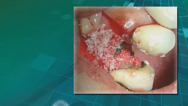 Использование гранул Bioteck BIOGEN для вертикальной и горизонтальной аугментации смотреть онлайн