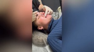 Розчинення губ ферментом Liporase. Відпрацювання на моделі