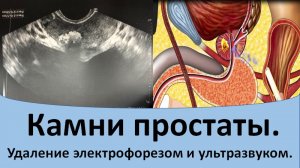 Камни простаты. Лечение электрофорезом и ультразвуком