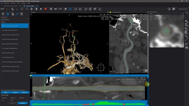 Carotid vessels analysis with dual scan bone removal in Inobitec DICOM Viewer Pro смотреть онлайн